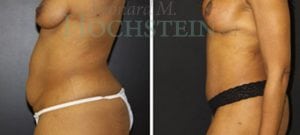 Mommy Makeover Patient