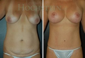 Mommy Makeover Patient
