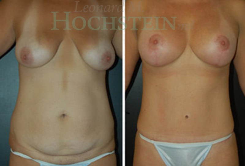 Mommy Makeover Patient