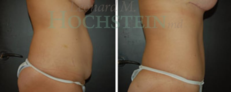 Mommy Makeover Patient