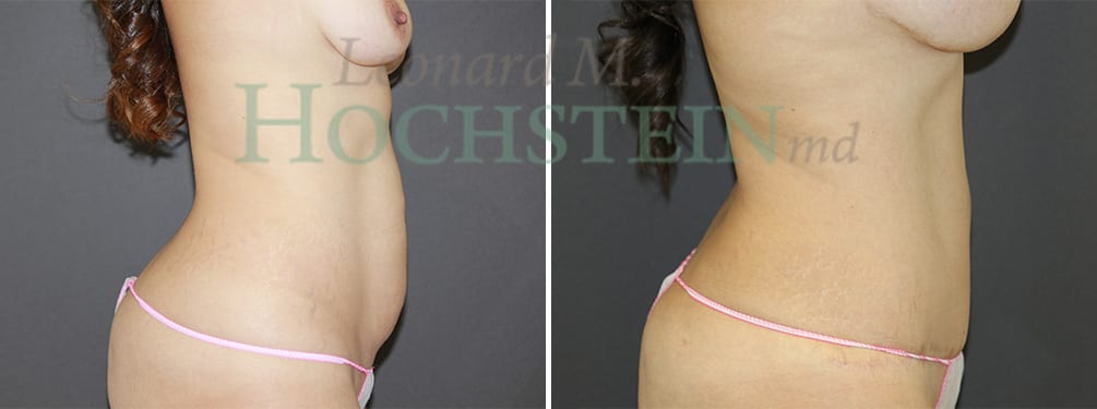 Mommy Makeover Patient