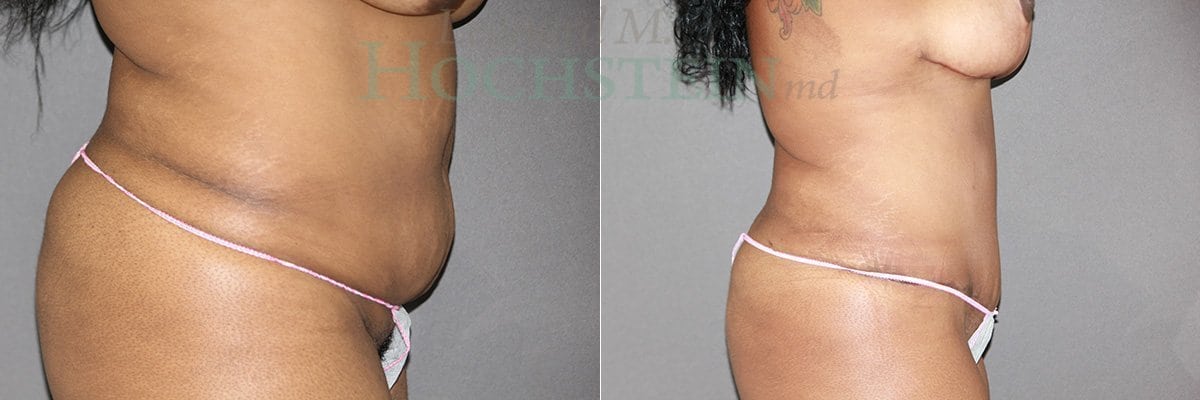 Mommy Makeover Patient