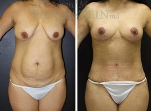 Mommy Makeover Patient 24