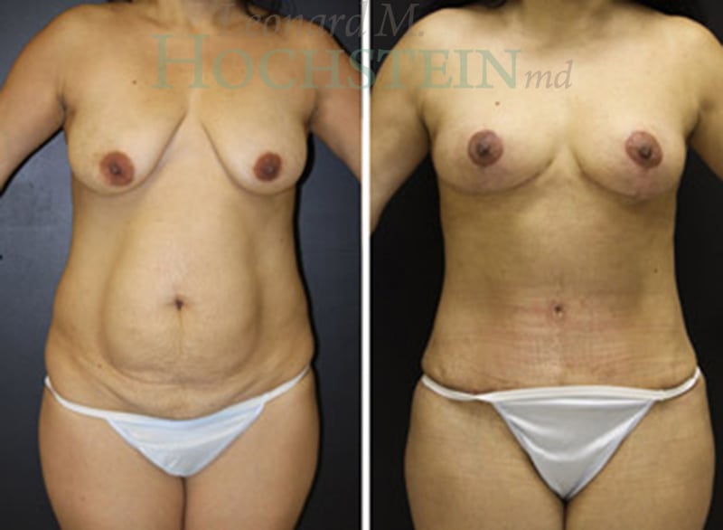 Mommy Makeover Patient