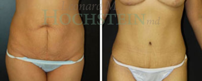 Mommy Makeover Patient