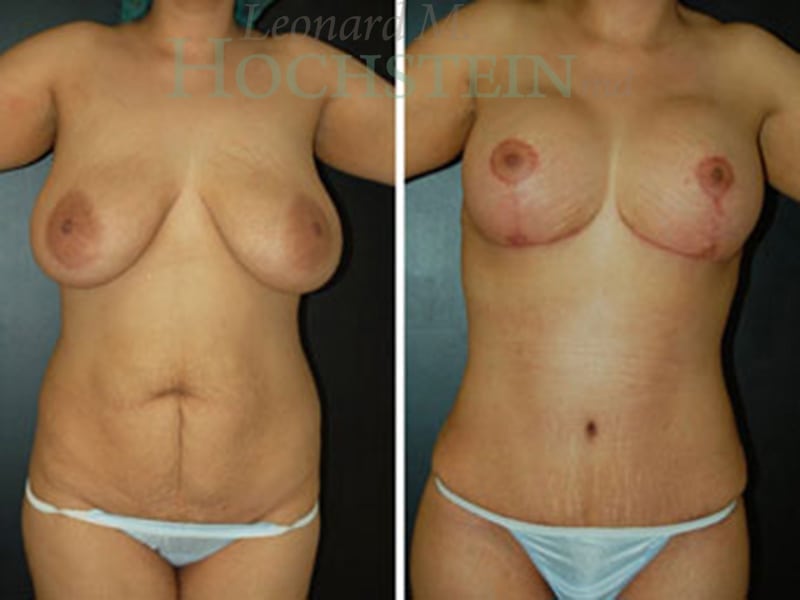 Mommy Makeover Patient