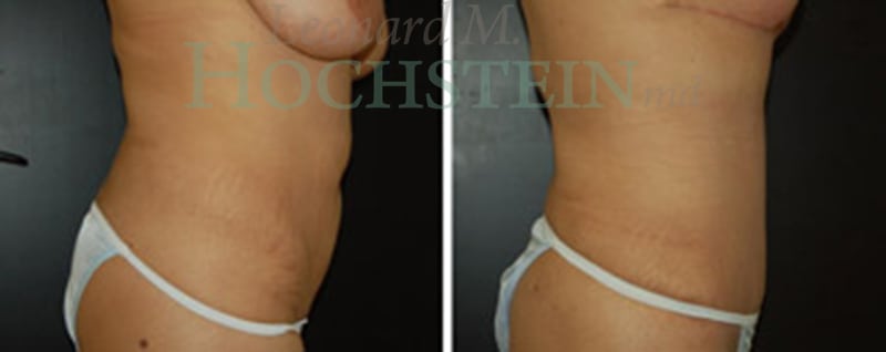 Mommy Makeover Patient