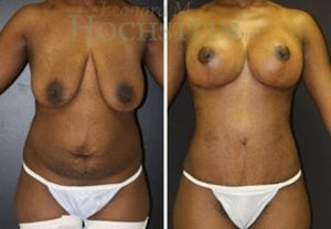 Mommy Makeover Patient