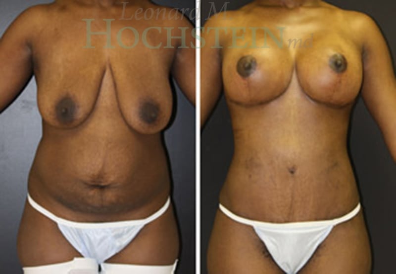 Mommy Makeover Patient