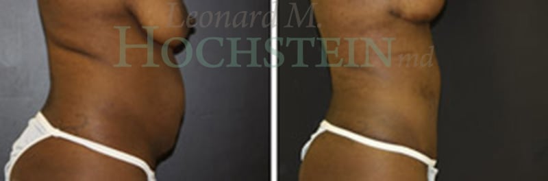 Mommy Makeover Patient