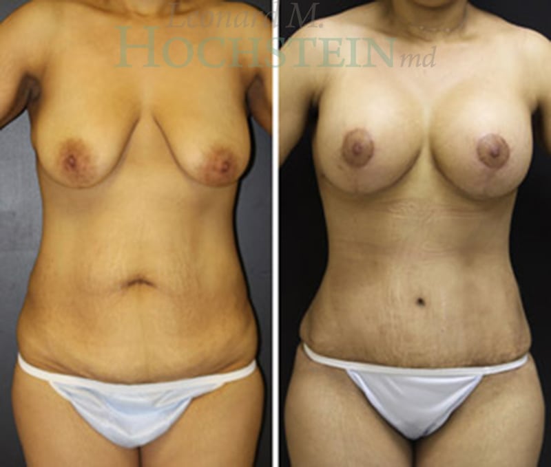 Mommy Makeover Patient