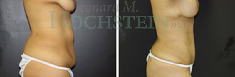 Mommy Makeover Patient