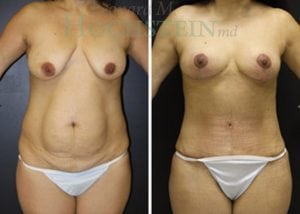 Mommy Makeover Patient