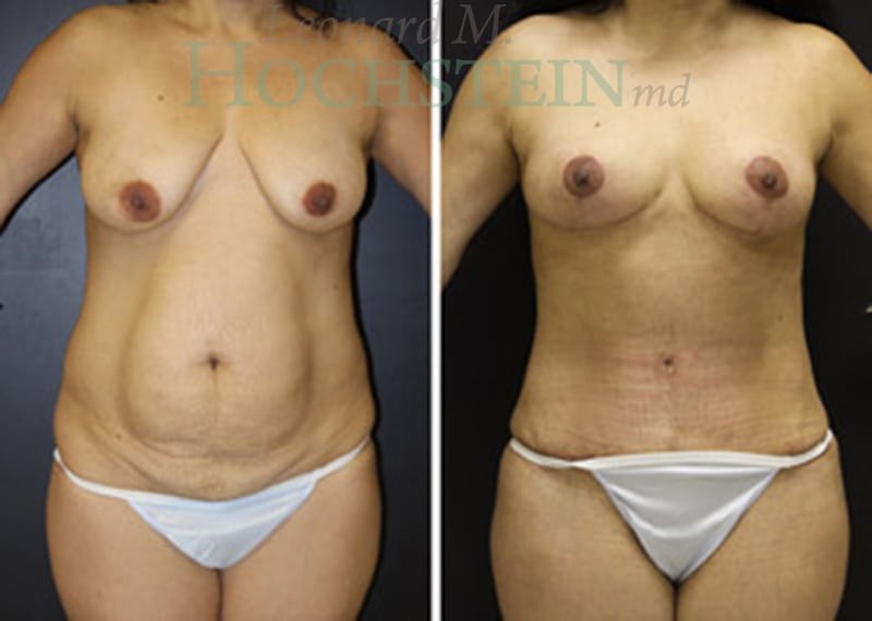 Mommy Makeover Patient