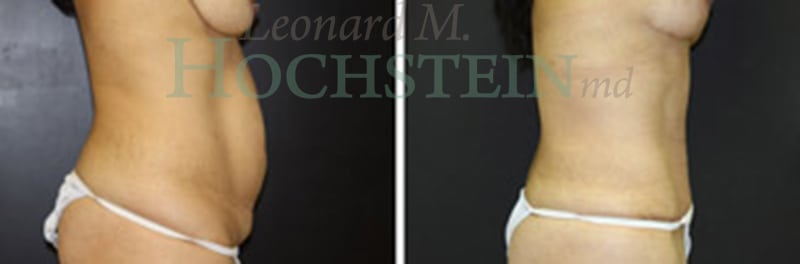 Mommy Makeover Patient