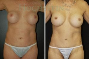 Mommy Makeover Patient