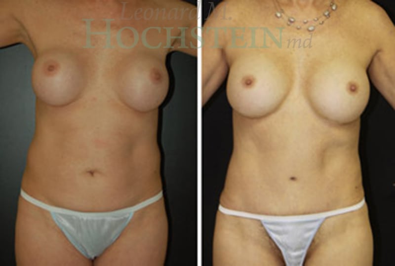 Mommy Makeover Patient