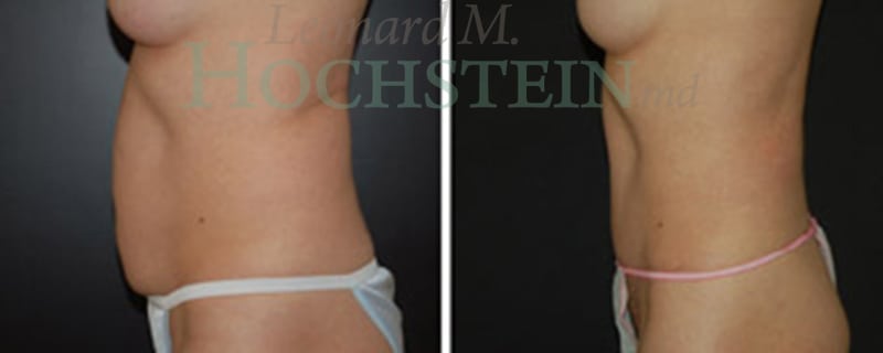 Mommy Makeover Patient