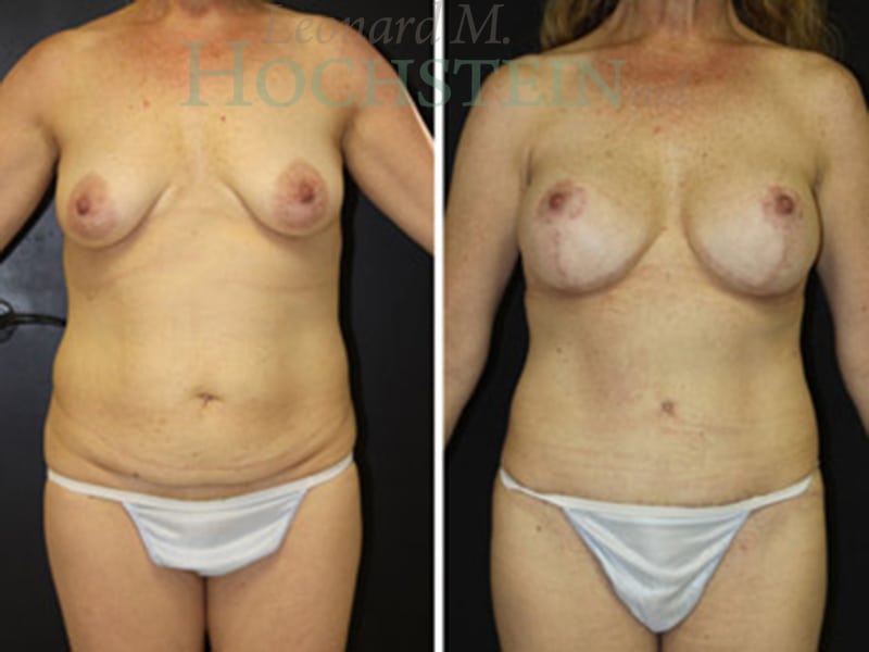 Mommy Makeover Patient