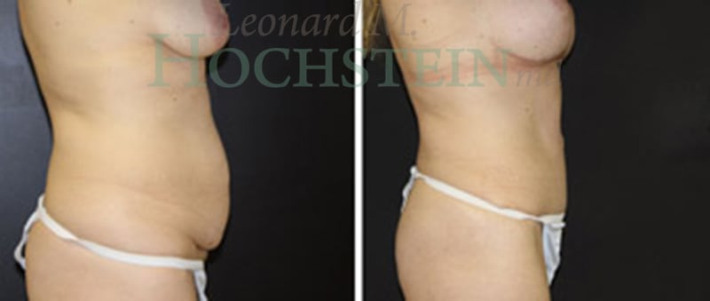 Mommy Makeover Patient