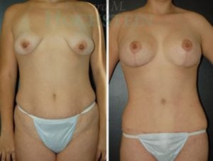 Mommy Makeover Patient