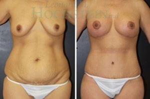 Mommy Makeover Patient
