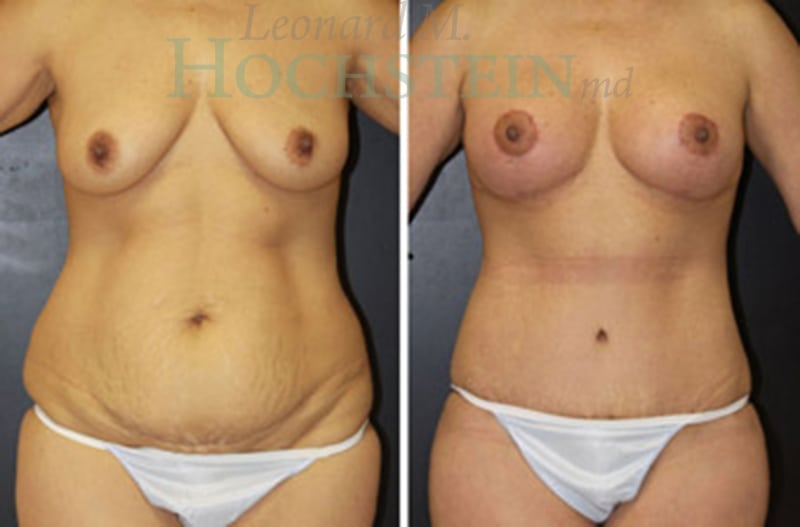 Mommy Makeover Patient