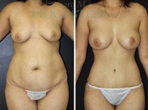 Mommy Makeover Patient