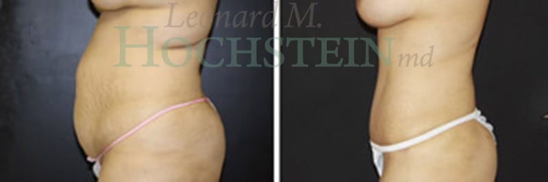 Mommy Makeover Patient