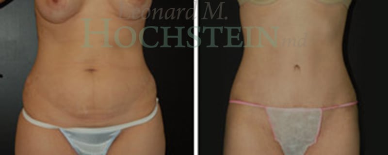 Mommy Makeover Patient