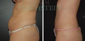 Mommy Makeover Patient