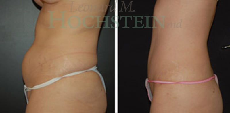 Mommy Makeover Patient