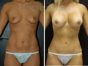 Mommy Makeover Patient