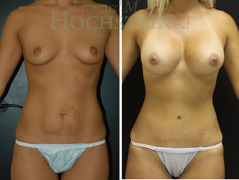 Mommy Makeover Patient