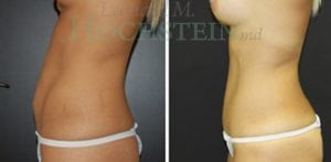 Mommy Makeover Patient