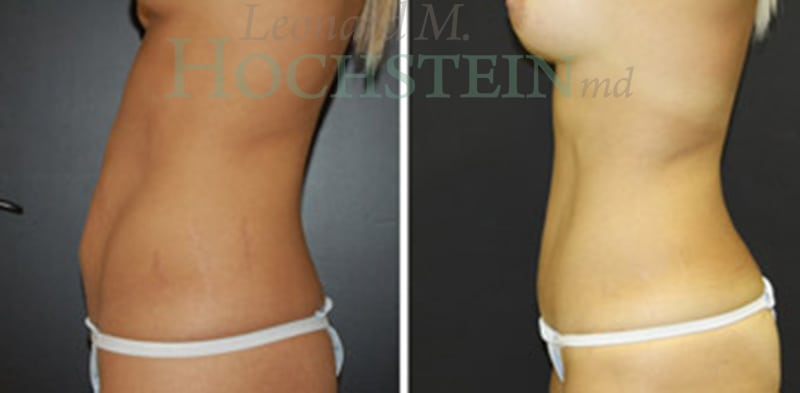 Mommy Makeover Patient