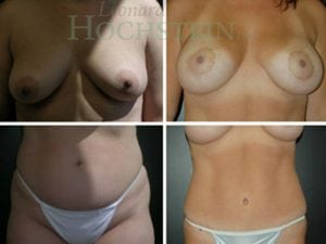 Mommy Makeover Patient 36