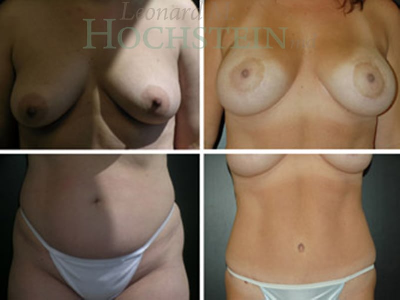 Mommy Makeover Patient