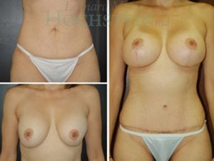 Mommy Makeover Patient 37