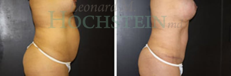 Mommy Makeover Patient