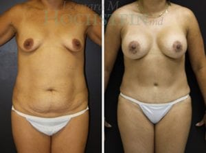 Mommy Makeover Patient