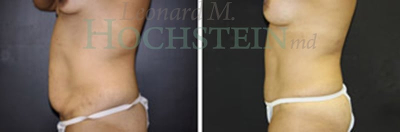 Mommy Makeover Patient