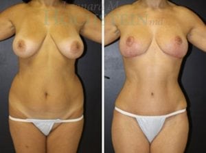 Mommy Makeover Patient