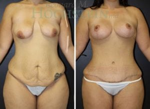 Mommy Makeover Patient