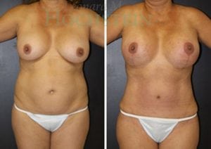 Mommy Makeover Patient 42