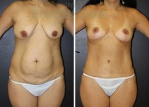 Mommy Makeover Patient