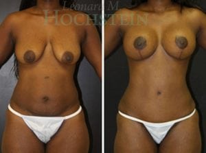 Mommy Makeover Patient