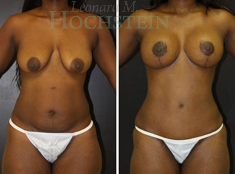 Mommy Makeover Patient