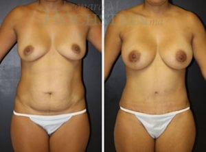 Mommy Makeover Patient