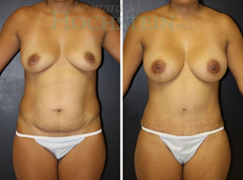 Mommy Makeover Patient